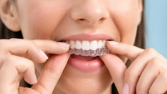 Mulher colocando placa oclusal transparente nos dentes